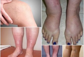 Photos de manifestations de varices dans les jambes