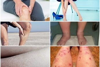 Symptômes de varices sur les jambes