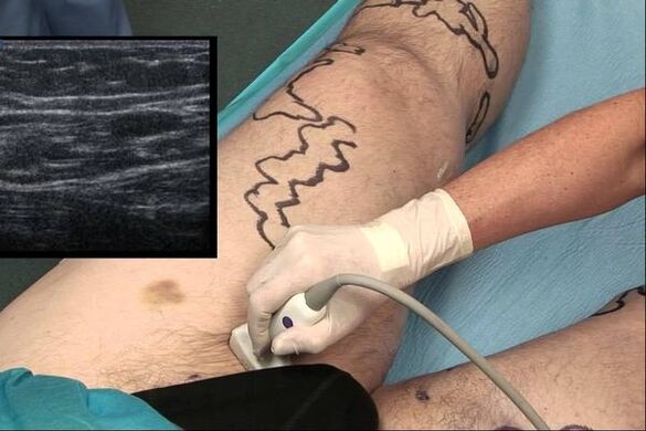Diagnostic des varices chez l'homme.