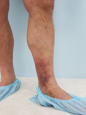 complications des varices chez les hommes