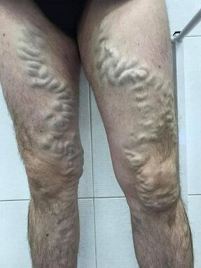 varices masculines négligées
