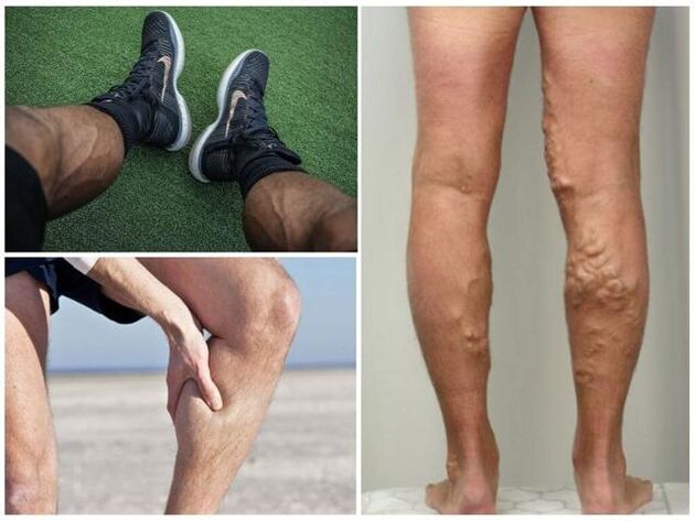 à quoi ressemblent les varices sur les jambes des hommes