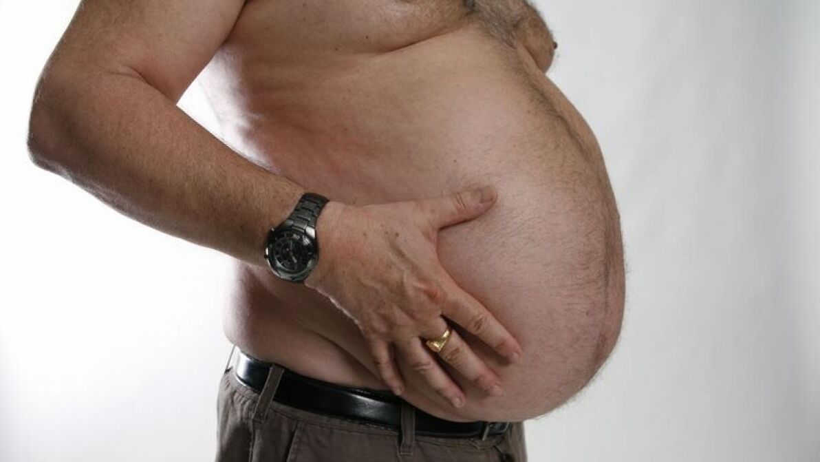L'obésité comme cause du développement des varices. 