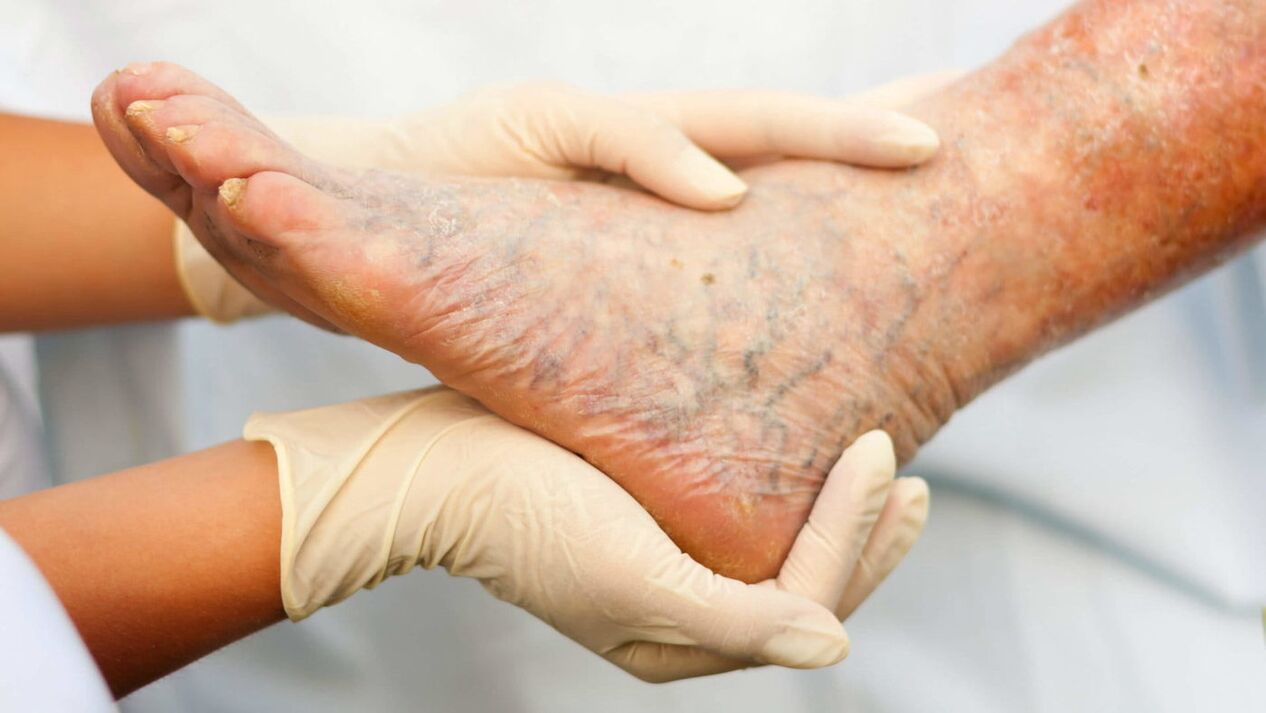 Le phlébologue s'occupe du traitement des varices des jambes. 