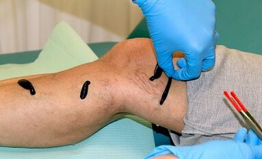 Hirudothérapie pour les varices