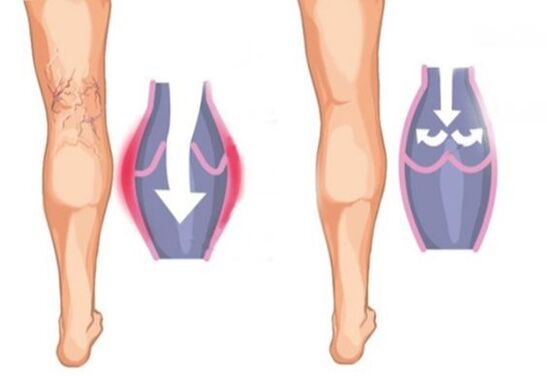 à quoi ressemblent les varices